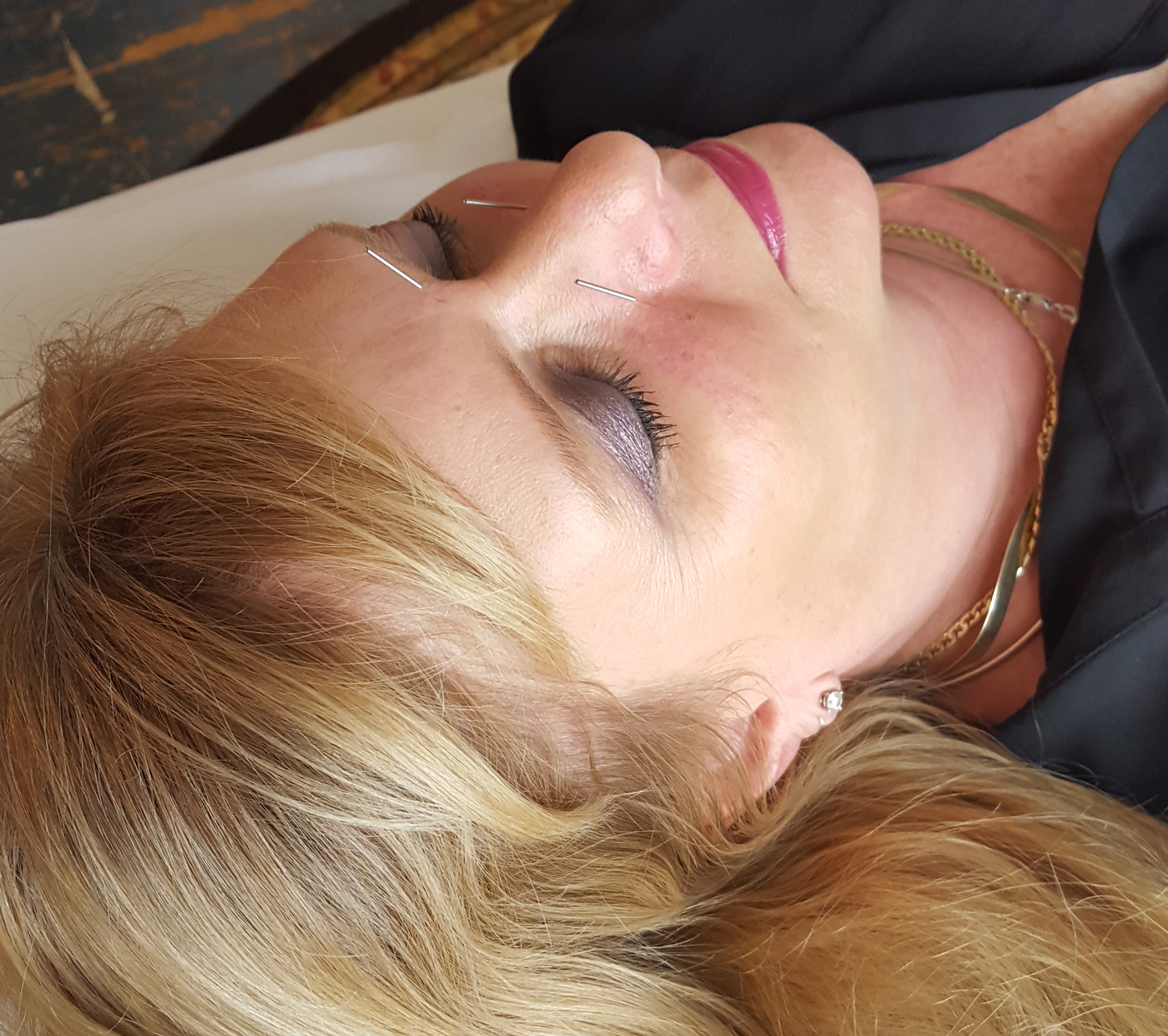 Acupuncture session with a licensed acupuncturist in Naperville